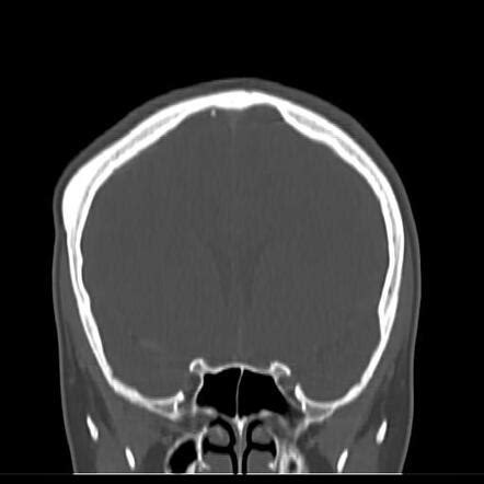 Skull Vault Osteoma Image Radiopaedia Org