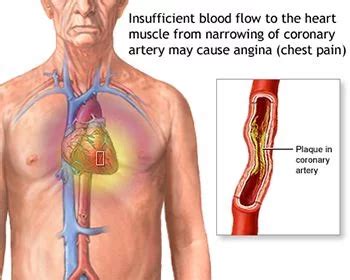 Chest Pain Treatment | Best Internal Medicine Doctors in Brooklyn