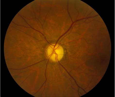 Optic nerve atrophy causes, symptoms, diagnosis & treatment