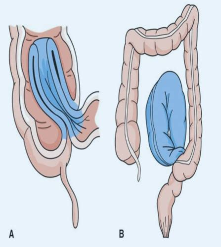 Respiratory Disorders And GI Flashcards Quizlet