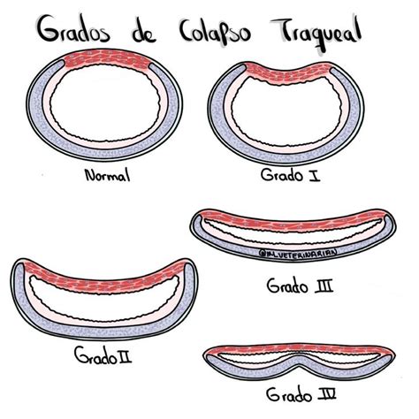 Grados De Colapso Traqueal