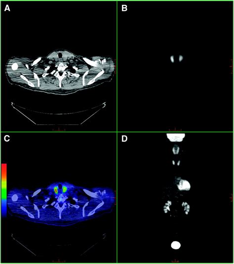 Clinical Significance Of Diffusely Increased 18f Fdg Uptake In The