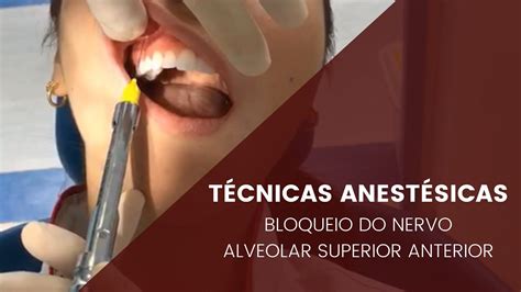 T Cnicas Anest Sicas Bloqueio Do Nervo Alveolar Anterior Youtube