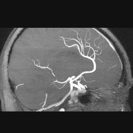 Azygos Anterior Cerebral Artery Radiology Reference Article