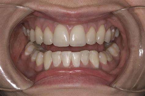 Before And After Gallery Envision Dental Dentist In Marietta Ga