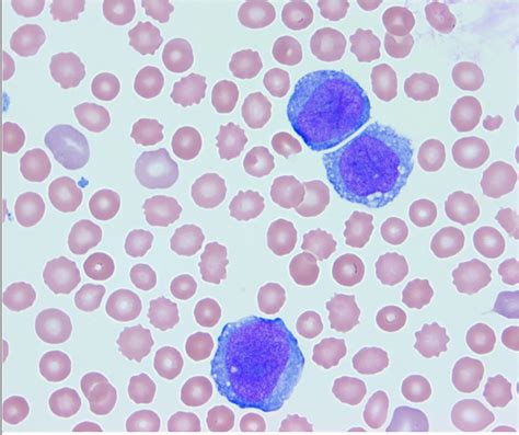 case 19 - Pedhepath: case-based learning IN pediatric hematopathology