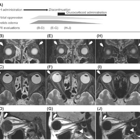 Thyroid Gland Uptake Of 123 I Scintigraphy Diffuse Uptake Of 123 I By