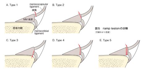 ramp lesion - 시보드