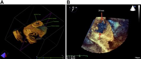 A Three Dimensional Transesophageal Echocardiography 3dtee Showing