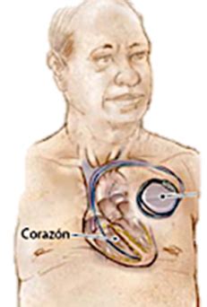 Implante De Cardiodesfibrilador Unicameral Bicameral Dr William