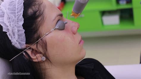 Laserul Genesis cea mai eficientă tehnică pentru rejuvenare facială