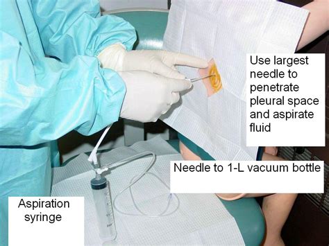 Clinical Notes: Thoracentesis: A Step-by-Step Procedure Guide with Photos