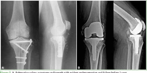 Figure 3 from Total Knee Replacement After High Tibial Osteotomy ...