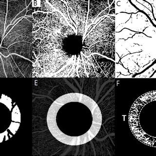 Representative Swept Source Optical Coherence Tomography Angiography