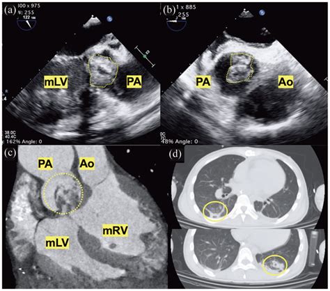 Preoperative Findings A And B Transesophageal Echocardiography And Download Scientific