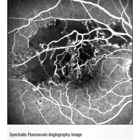 Heidelberg Spectralis Fluorescein Angiography Module Innova