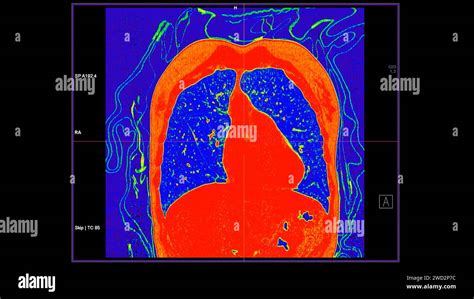 Ct Scan Of Chest Coronal View In Color Mode For Diagnostic Pulmonary