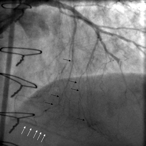 —cine Angiography In The Right Anterior Oblique Cranial Project Of The Download Scientific