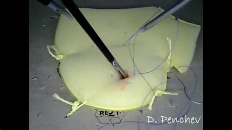 Purse Suture Youtube