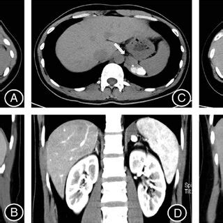 Abdominal Contrast Enhanced Computed Tomography Scans Of The Lesions In