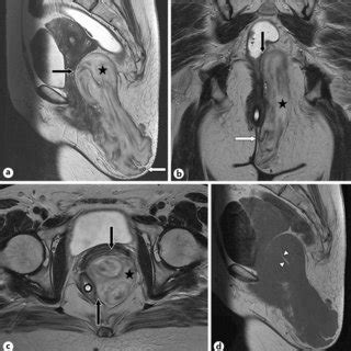 Axial T Weighted Mr Image A D And Axial Dwi B C E In A