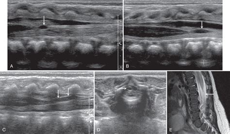 The Pediatric Spinal Canal Clinical Tree