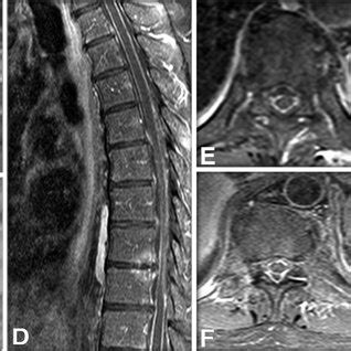 Case Preoperative T Weighted Mri Sequences With Gd Enhancement Of