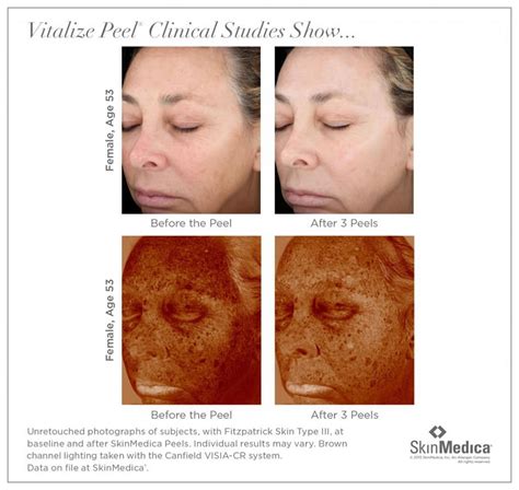 Vitalize Peel Recovery