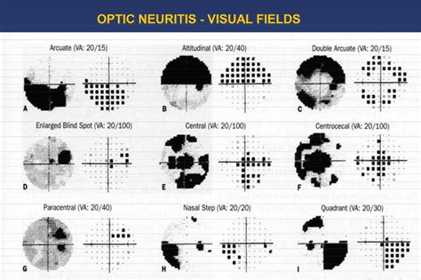 Visual Field Defect Map