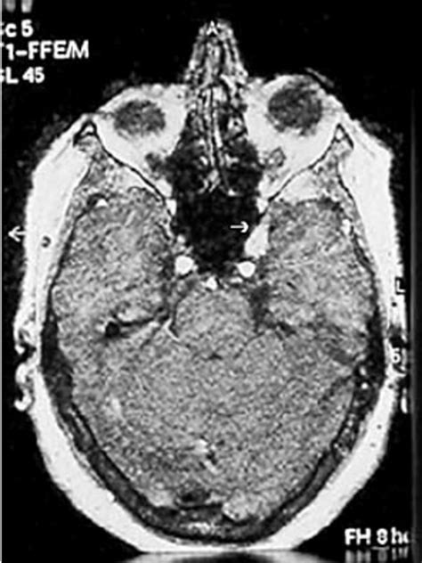 T1 Weighted Axial Magnetic Resonance Image There Is Dilation Of The