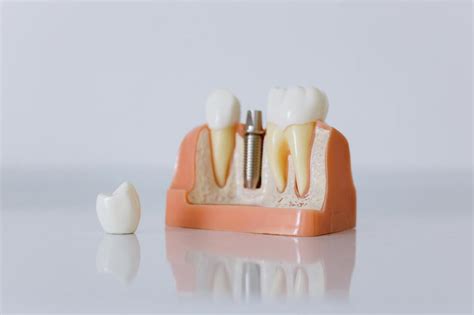 CEMENT VERSUS SCREW RETAINED IMPLANT RESTORATIONS - The Dental Lab