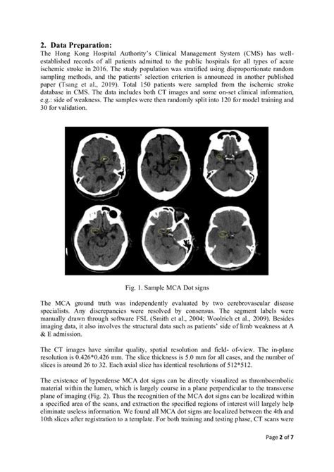 Automated Segmentation For Hyperdense Middle Cerebral Artery Sign Of