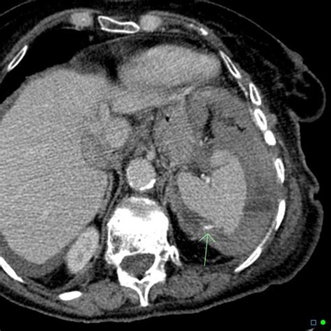 Brown Hospital Medicine On Twitter A 85 Year Old Woman Presented With