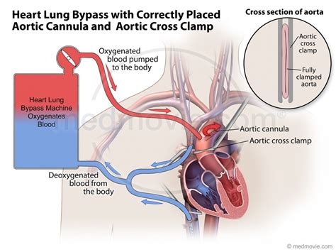 Heart Lung Bypass With Correctly Placed Aortic Cannula And Cross Clamp