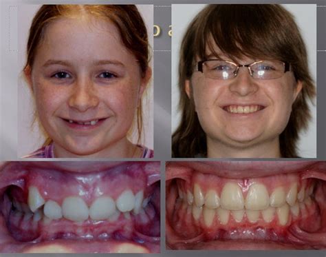 Dr William Thomas' Orthodontic Blog: The Value of Damon Braces