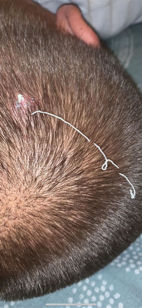 Health guide explains why new cyst popping videos are so satisfying 13