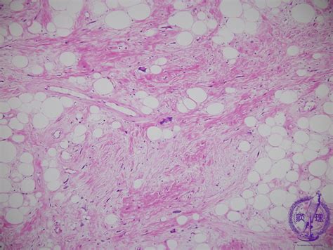 18soft Tissue 1 Lipoma Liposarcomasclerosing Liposarcoma