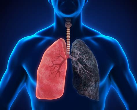 O'que É Enfisema Pulmonar - Tudo sobre Enfisema Pulmonar: Sintomas, Diagnóstico e Tratamento