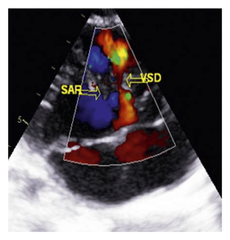 A Cross Sectional Echocardiogram In The Long Axis Parasternal View Of