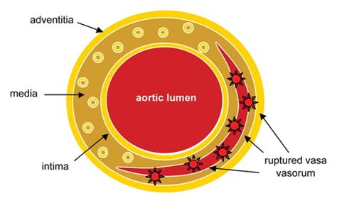 Aortic Hematoma