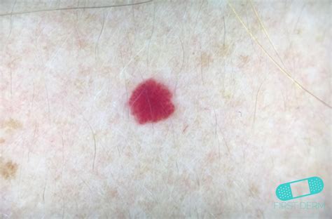 Online Dermatology - Angioma