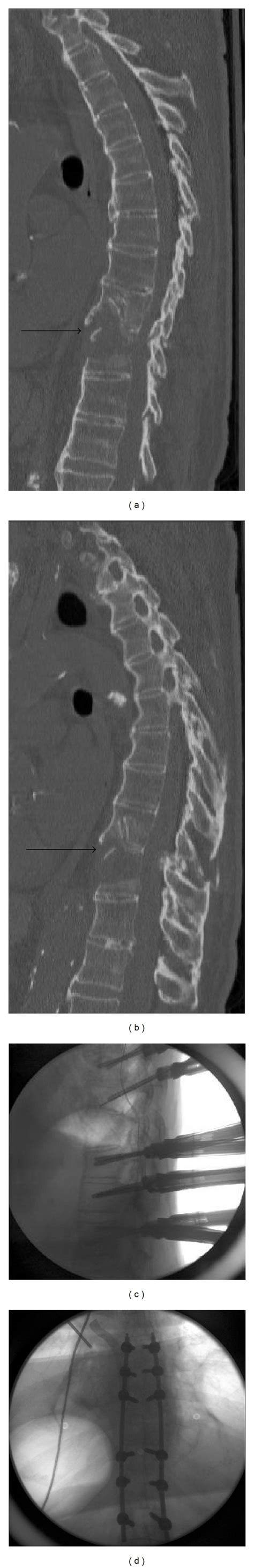 Sagittal Computed Tomography A And B Of An Octagenarian Male With A Download Scientific