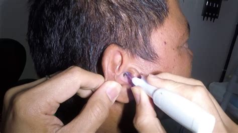 Man S Massive Earwax Extraction Youtube