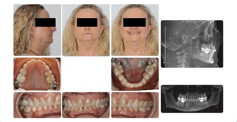 Initial Extraoral And Intraoral Photos With Initial Cephalometric And