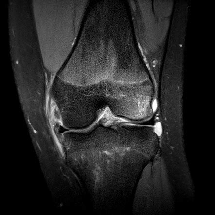 Medial Collateral Ligament Injury Of The Knee Radiology Reference