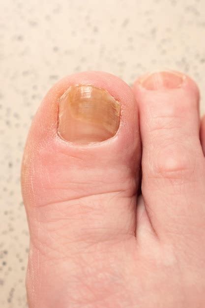 Uñas de los pies con infección por hongos y hematomas en la macro del