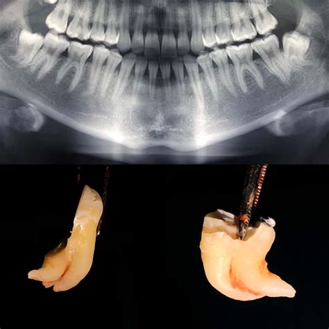 Denti Del Giudizio Tutto Quello Che Bisogna Sapere