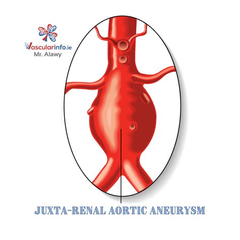 Complex Endovascular Repair Of Aortic Aneurysms