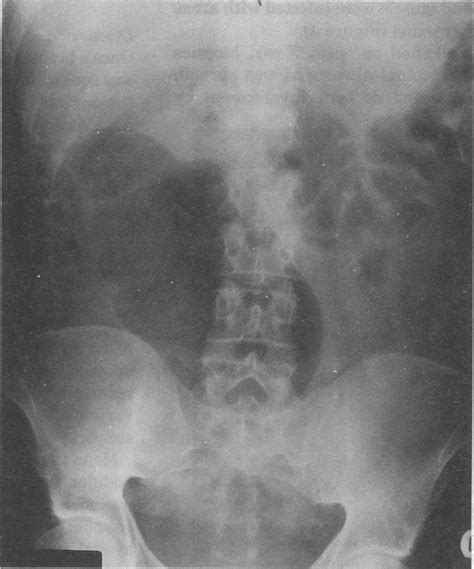 Supine Abdominal X Ray Demonstrating Distended Caecum