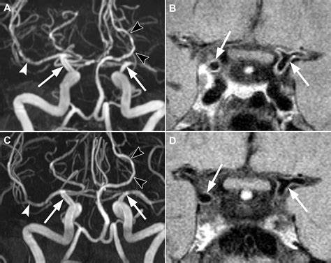 The Use And Pitfalls Of Intracranial Vessel Wall Imaging How We Do It